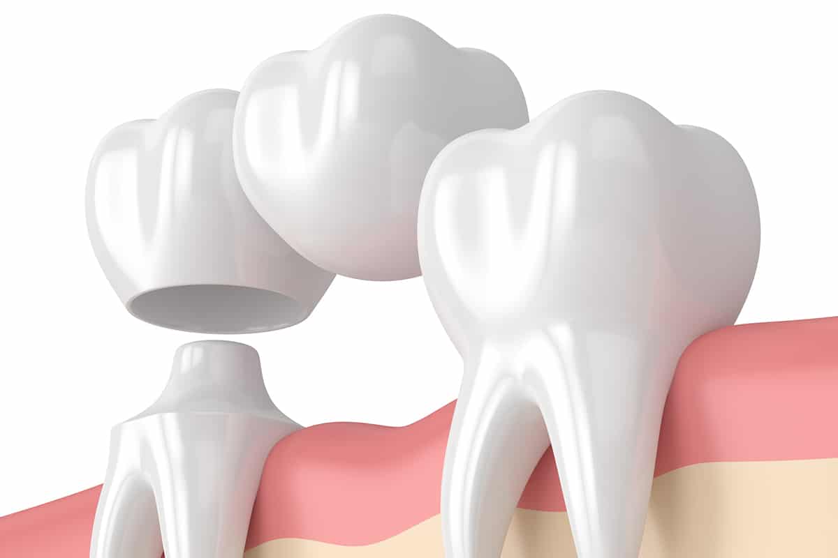 How Much Does A Dental Bridge Cost In Snellville Ga