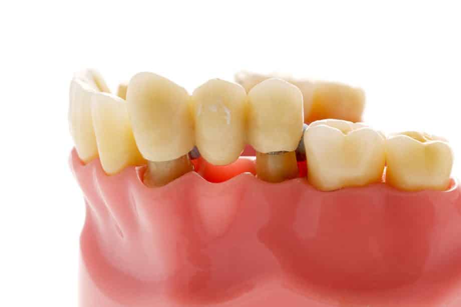 How Should A Dental Bridge Fit?