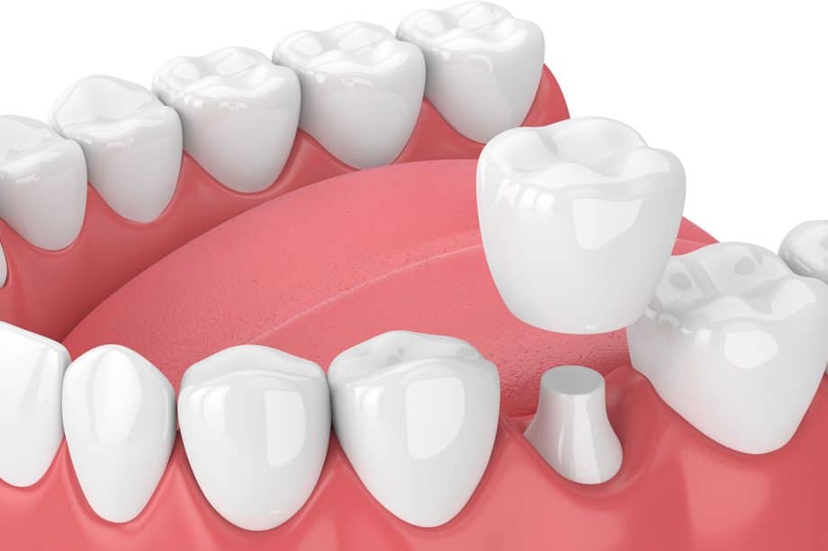 What Are Dental Crowns Made Of?