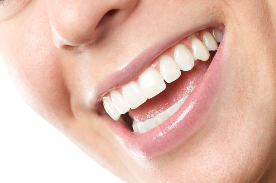 What Are Dental Veneers?