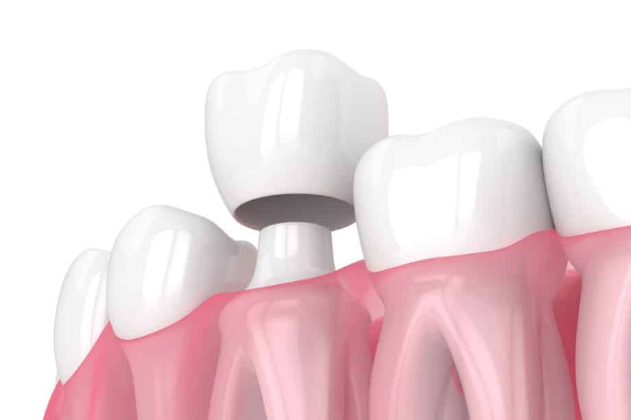 What Do I Do If My Tooth Is Cracked Underneath My Crown?